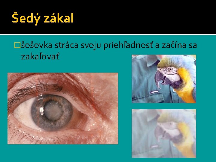 Šedý zákal �šošovka stráca svoju priehľadnosť a začína sa zakaľovať 