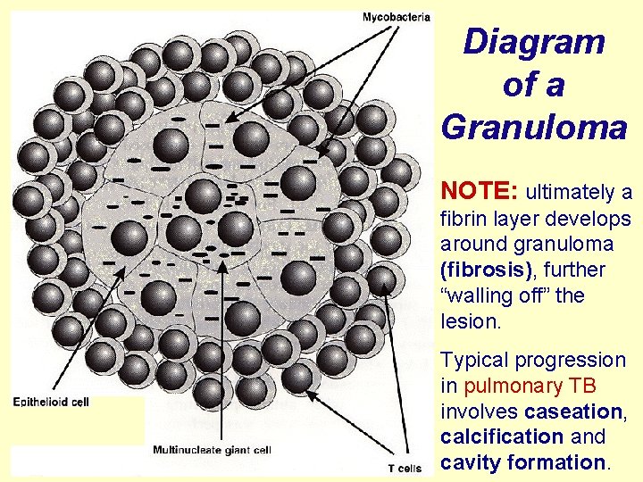 Diagram of a Granuloma NOTE: ultimately a fibrin layer develops around granuloma (fibrosis), further
