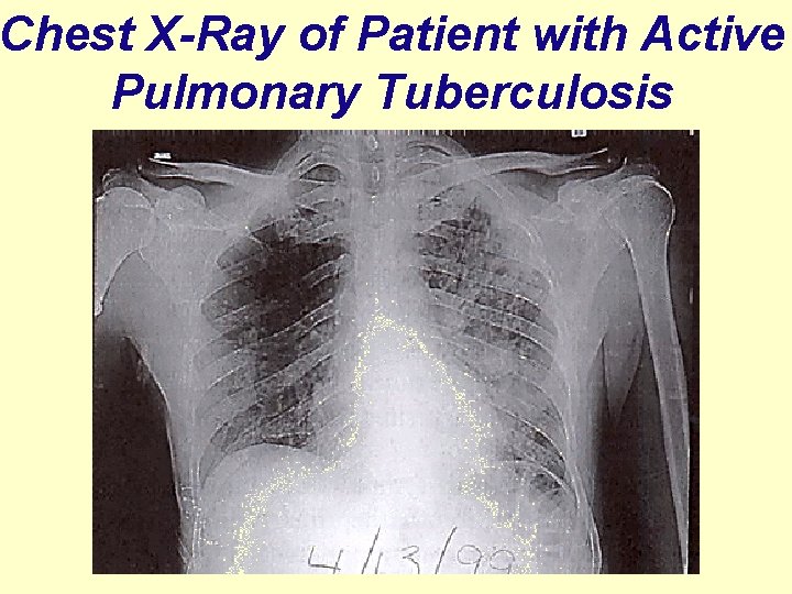 Chest X-Ray of Patient with Active Pulmonary Tuberculosis 