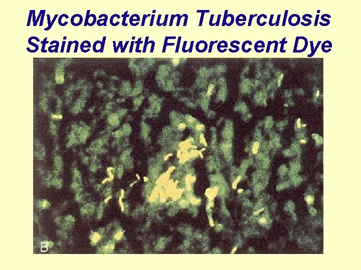 Mycobacterium Tuberculosis Stained with Fluorescent Dye 