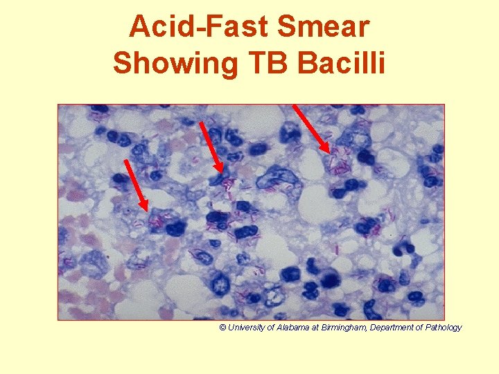 Acid-Fast Smear Showing TB Bacilli © University of Alabama at Birmingham, Department of Pathology