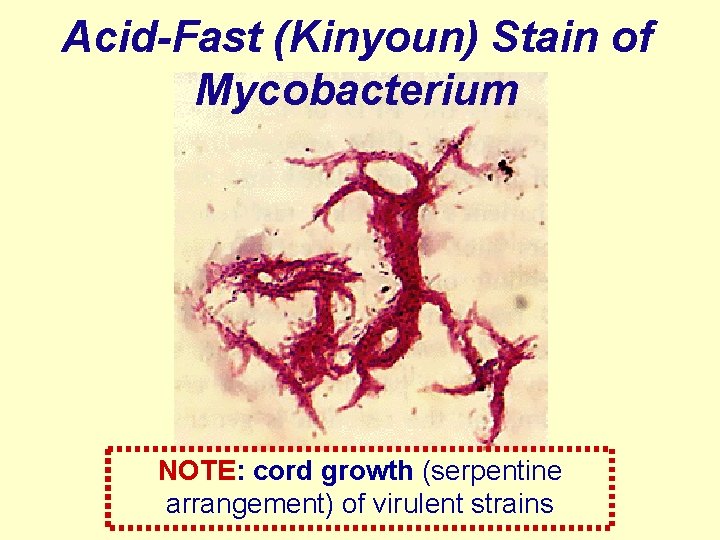Acid-Fast (Kinyoun) Stain of Mycobacterium NOTE: cord growth (serpentine arrangement) of virulent strains 