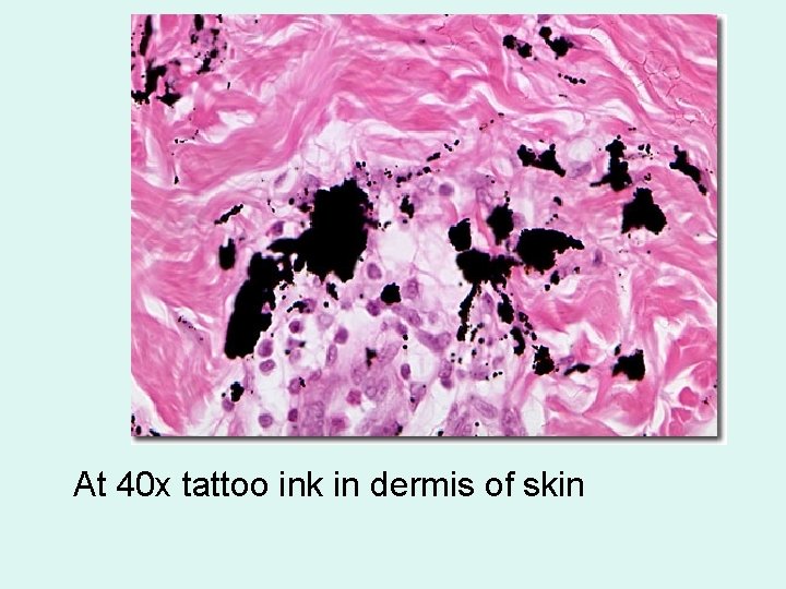 At 40 x tattoo ink in dermis of skin 