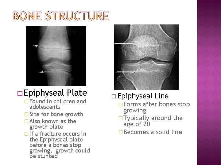 � Epiphyseal � Found Plate in children and adolescents � Site for bone growth