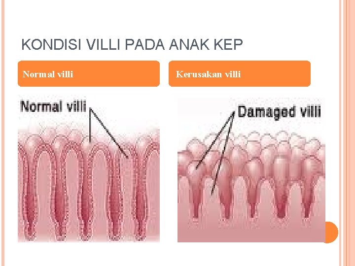 KONDISI VILLI PADA ANAK KEP Normal villi Kerusakan villi 