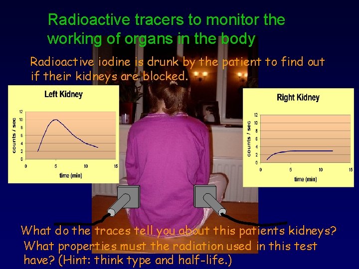 Radioactive tracers to monitor the working of organs in the body Radioactive iodine is
