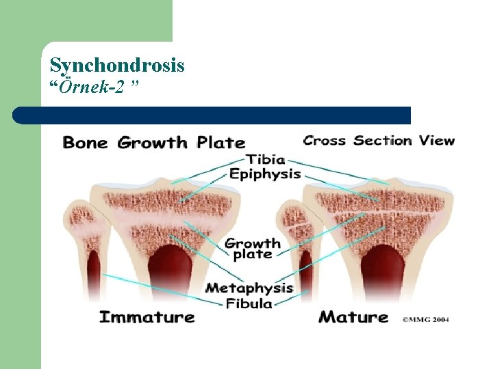 Synchondrosis “Örnek-2 ” 