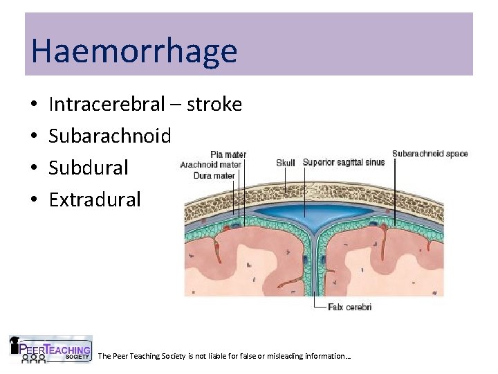 Haemorrhage • • Intracerebral – stroke Subarachnoid Subdural Extradural The Peer Teaching Society is