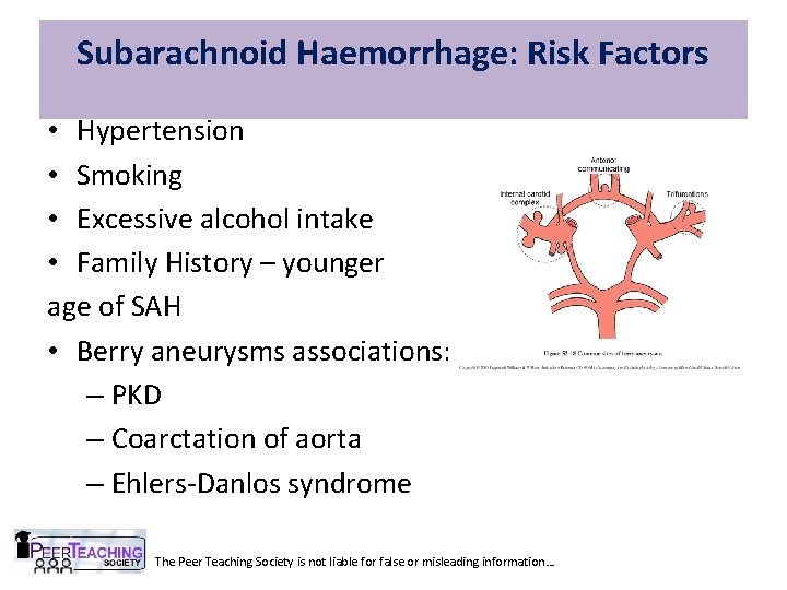 Subarachnoid Haemorrhage: Risk Factors • Hypertension • Smoking • Excessive alcohol intake • Family