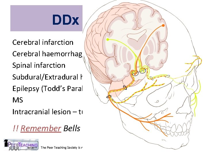 DDx Weakness: Cerebral infarction Cerebral haemorrhage Spinal infarction Subdural/Extradural haematoma Epilepsy (Todd’s Paralysis) MS