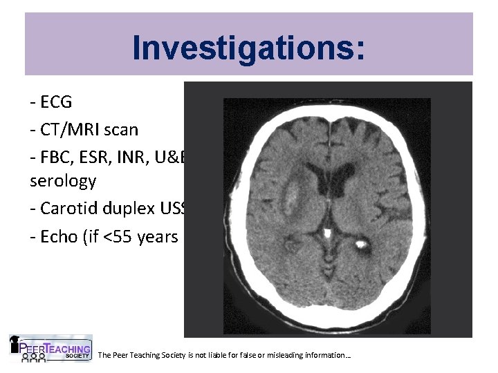 Investigations: - ECG - CT/MRI scan - FBC, ESR, INR, U&E, Glucose, Cholesterol, Syphillis