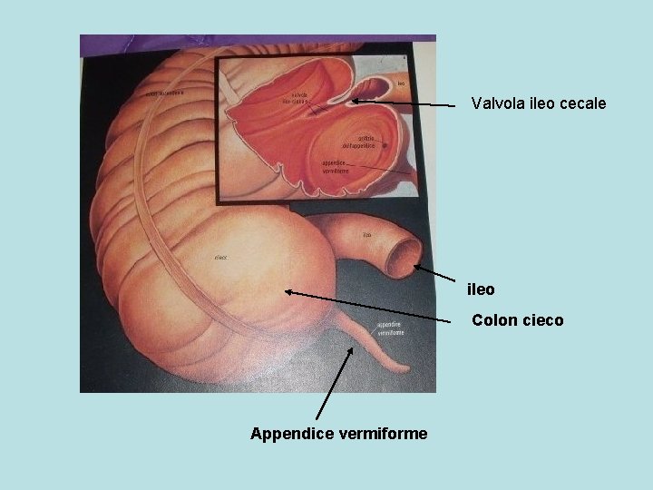 Valvola ileo cecale ileo Colon cieco Appendice vermiforme 