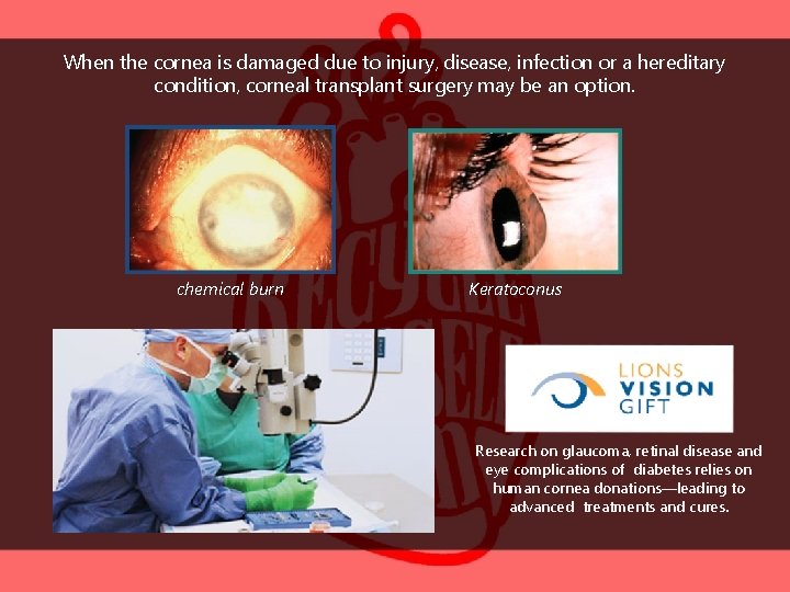 When the cornea is damaged due to injury, disease, infection or a hereditary condition,