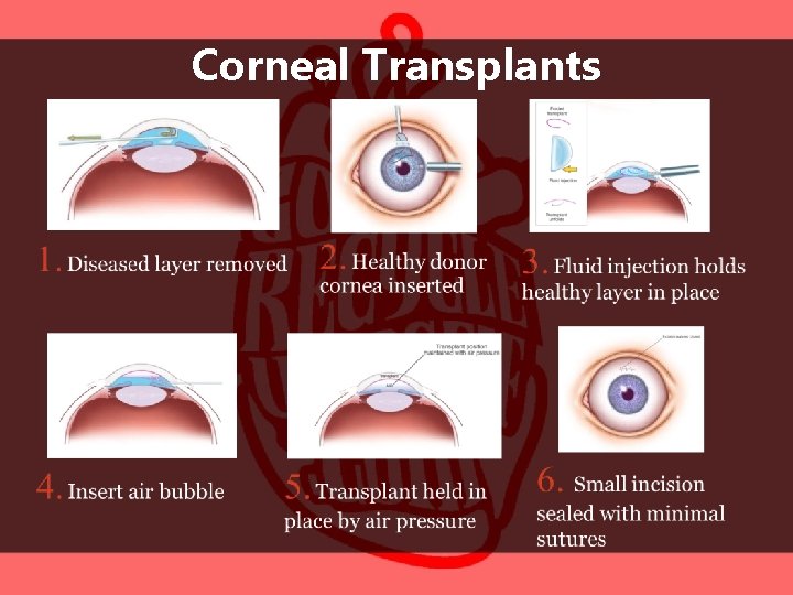 Corneal Transplants 