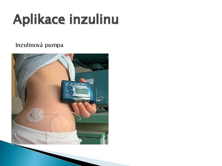 Aplikace inzulinu Inzulinová pumpa 