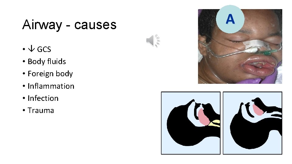 Airway - causes • GCS • Body fluids • Foreign body • Inflammation •