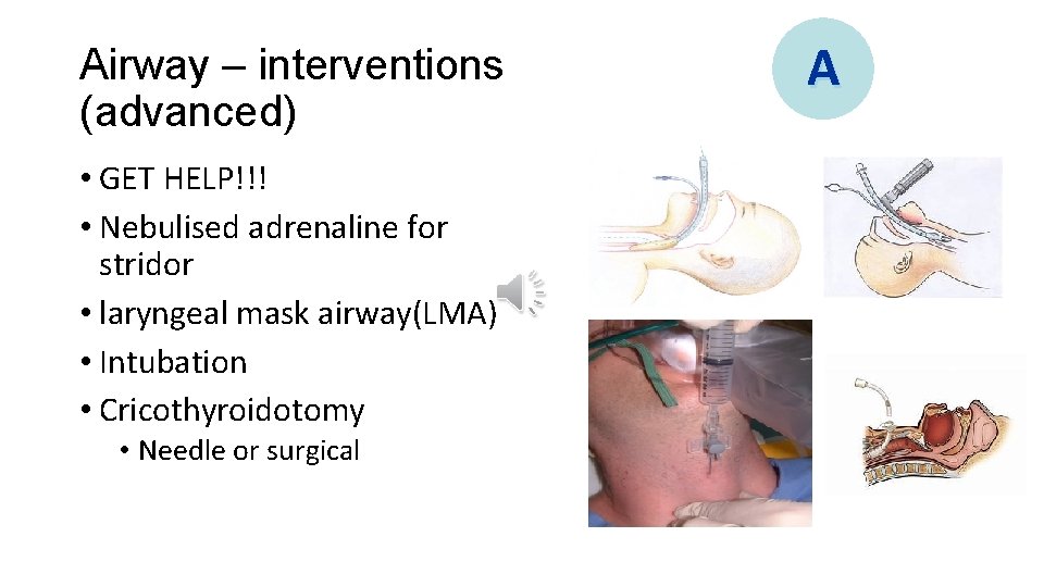 Airway – interventions (advanced) • GET HELP!!! • Nebulised adrenaline for stridor • laryngeal