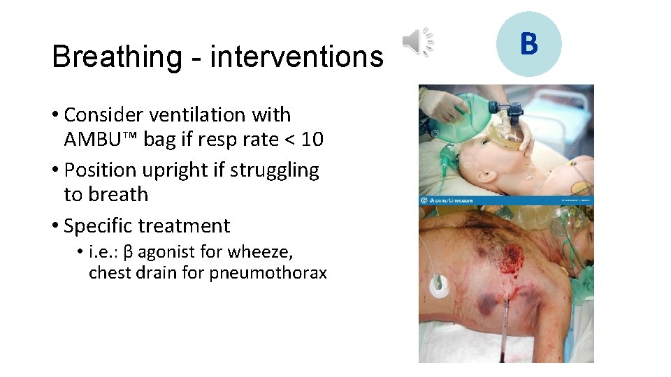 Breathing - interventions • Consider ventilation with AMBU™ bag if resp rate < 10