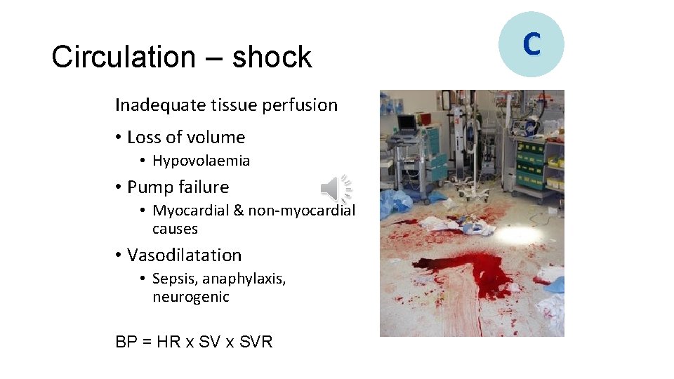 Circulation – shock Inadequate tissue perfusion • Loss of volume • Hypovolaemia • Pump