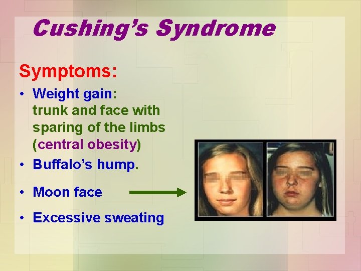 Cushing’s Syndrome Symptoms: • Weight gain: trunk and face with sparing of the limbs