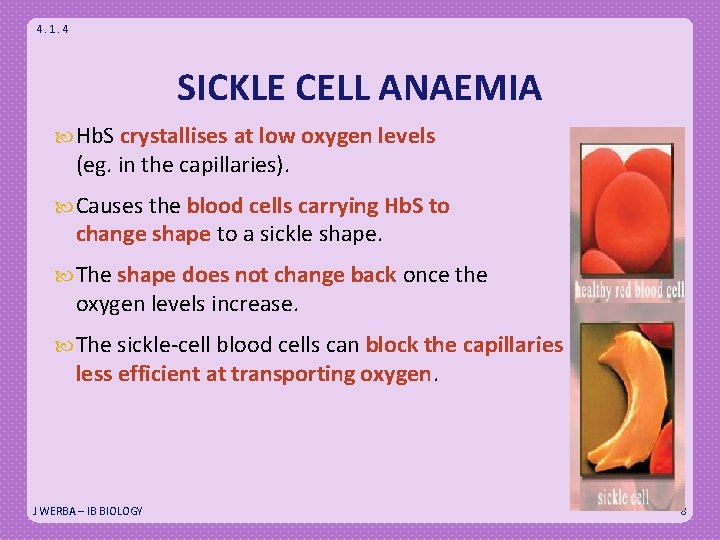 4. 1. 4 SICKLE CELL ANAEMIA Hb. S crystallises at low oxygen levels (eg.