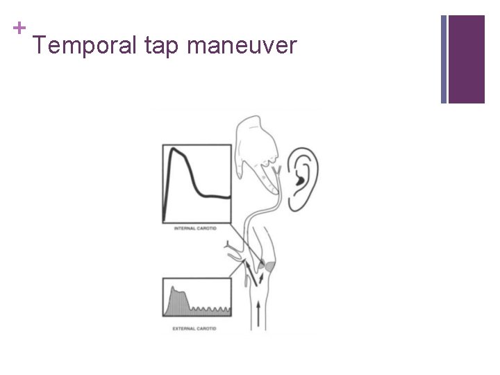 + Temporal tap maneuver 