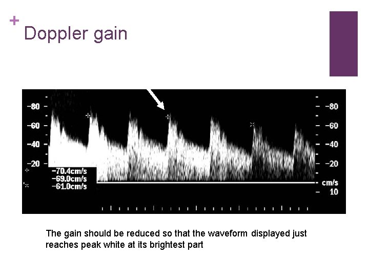 + Doppler gain The gain should be reduced so that the waveform displayed just