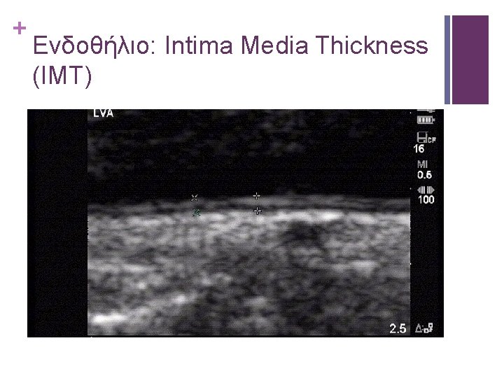 + Ενδοθήλιο: Intima Media Thickness (IMT) 
