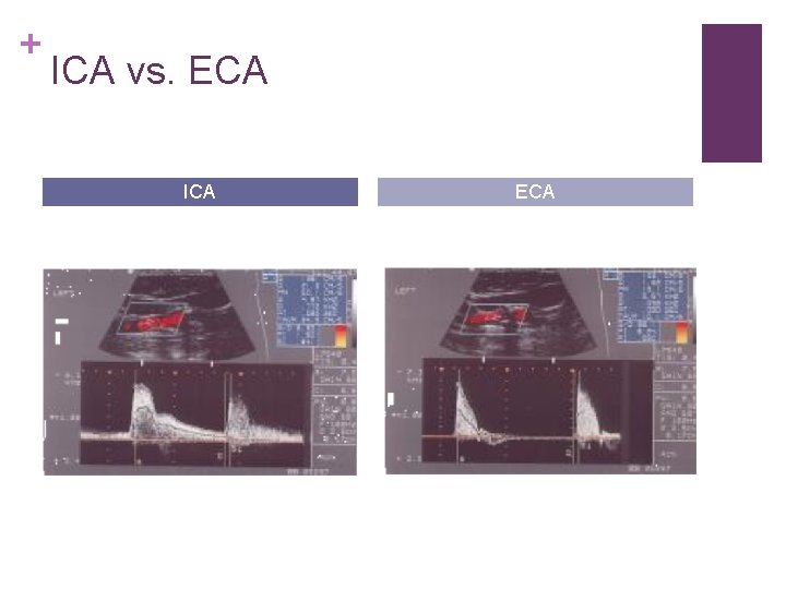 + ICA vs. ECA ICA ECA 