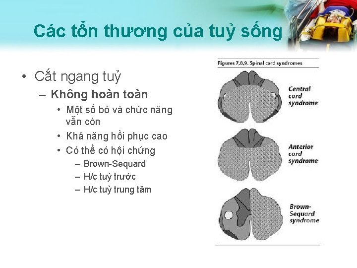 Các tổn thương của tuỷ sống • Cắt ngang tuỷ – Không hoàn toàn