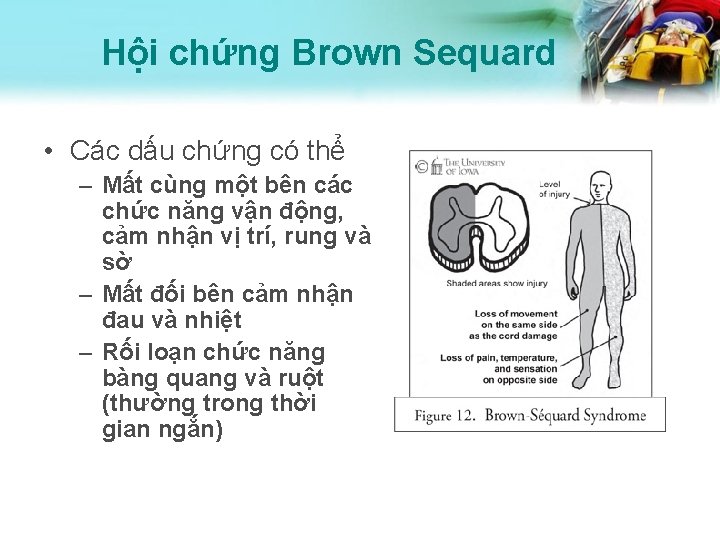 Hội chứng Brown Sequard • Các dấu chứng có thể – Mất cùng một