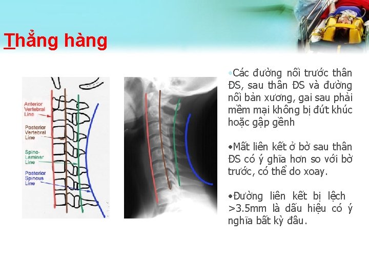 Thẳng hàng • Các đường nối trước thân ĐS, sau thân ĐS và đường