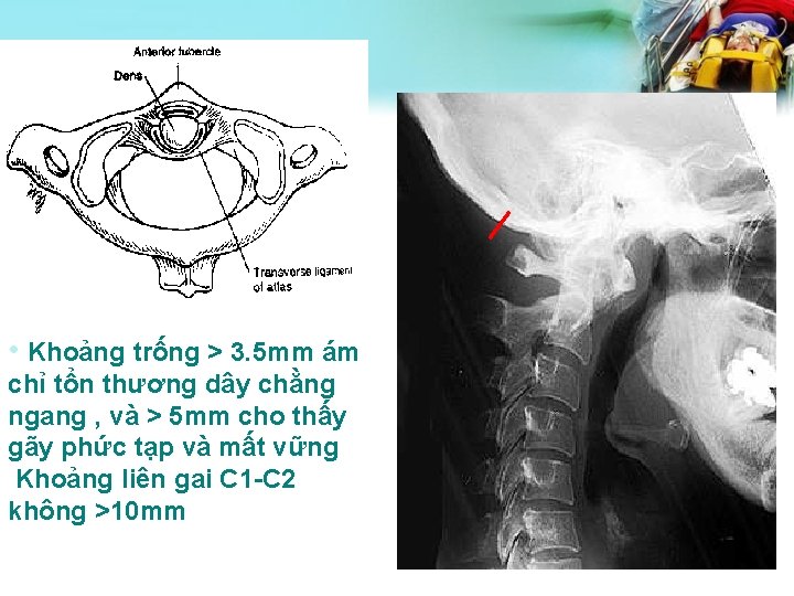  • Khoảng trống > 3. 5 mm ám chỉ tổn thương dây chằng