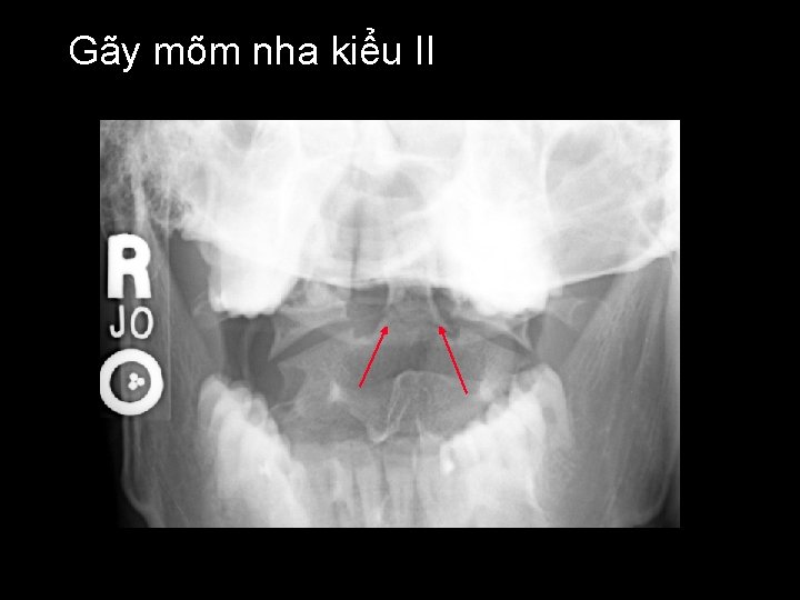 Gãy mõm nha kiểu II 