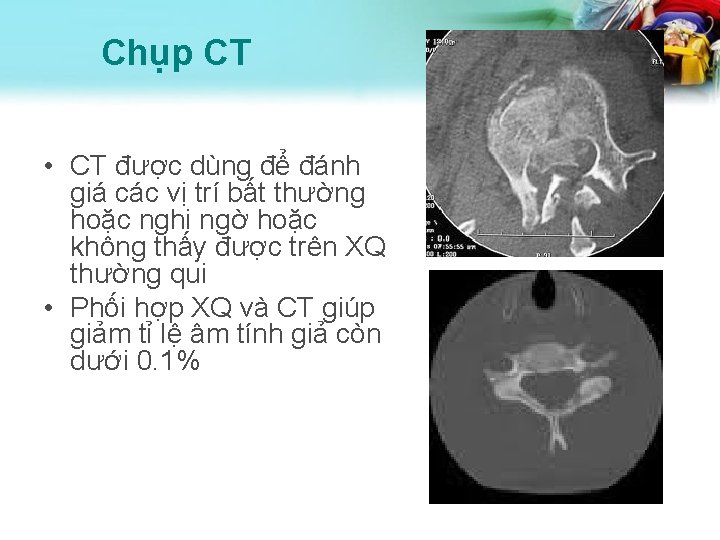 Chụp CT • CT được dùng để đánh giá các vị trí bất thường