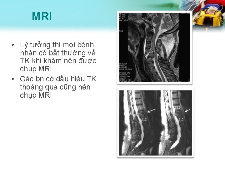 MRI • Lý tưởng thì mọi bệnh nhân có bất thường về TK khi