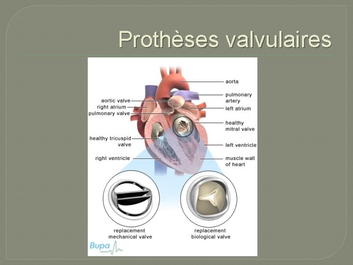 Prothèses valvulaires 