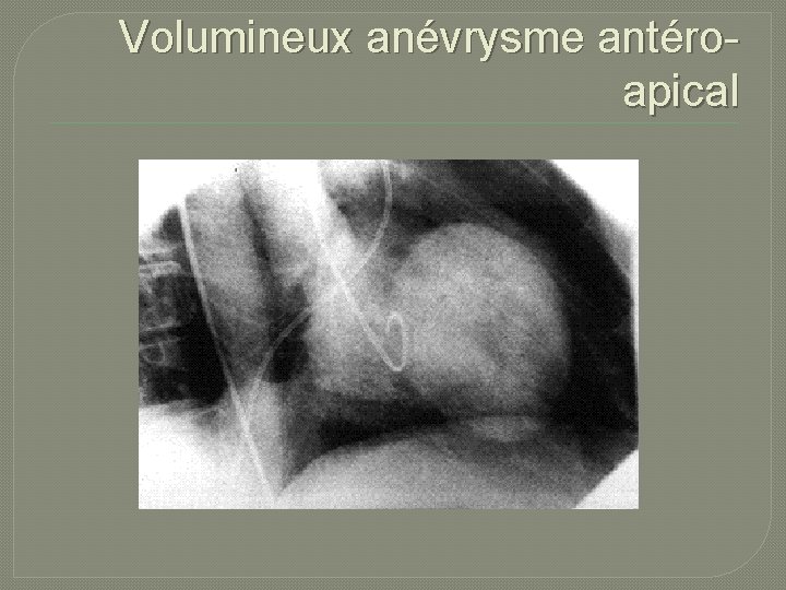 Volumineux anévrysme antéroapical 