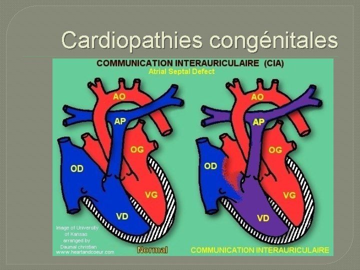 Cardiopathies congénitales 