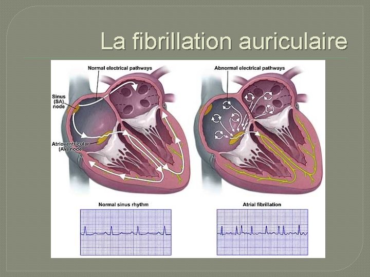 La fibrillation auriculaire 