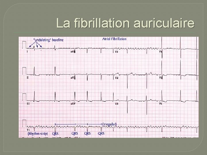 La fibrillation auriculaire 