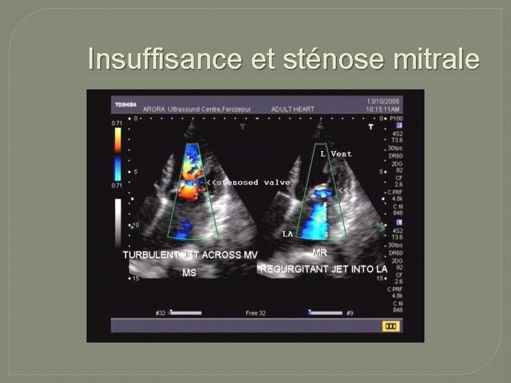 Insuffisance et sténose mitrale 