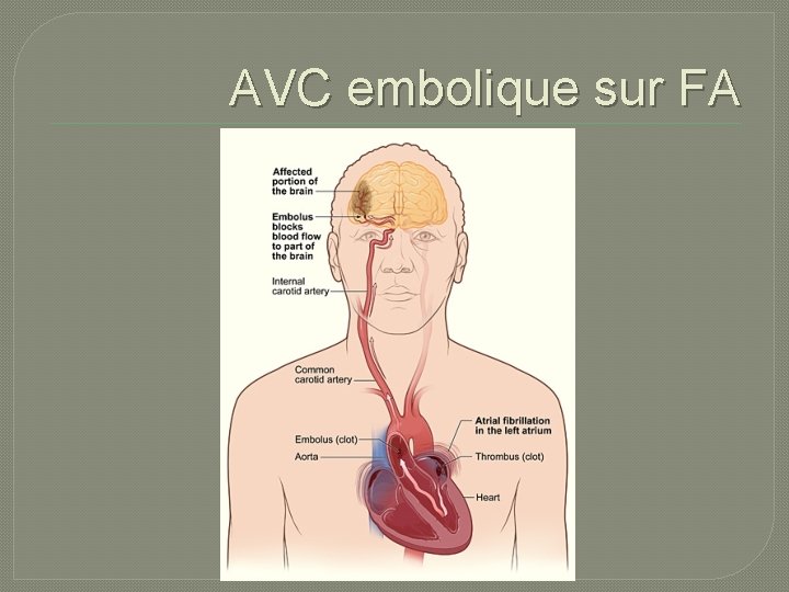 AVC embolique sur FA 