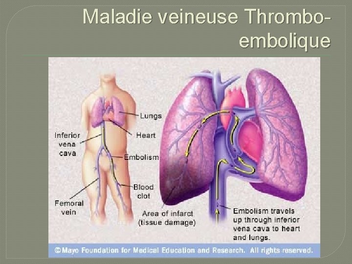 Maladie veineuse Thromboembolique 