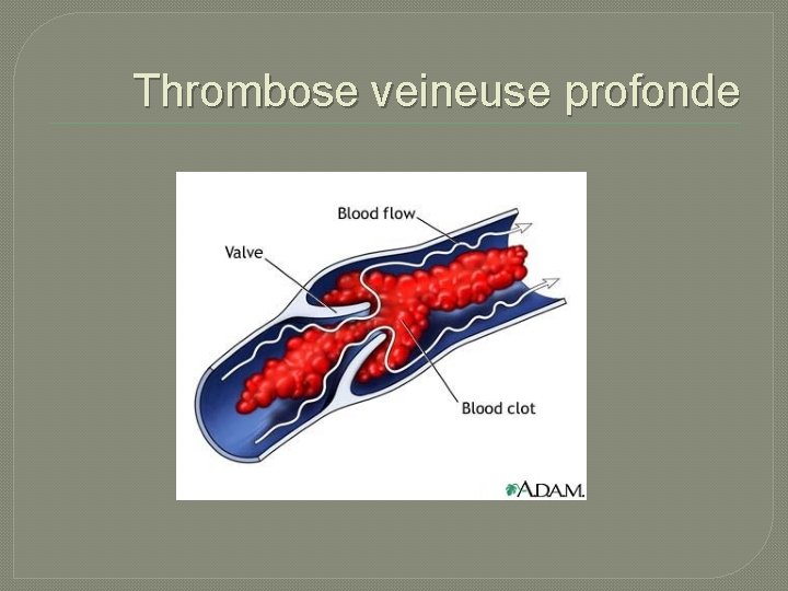 Thrombose veineuse profonde 