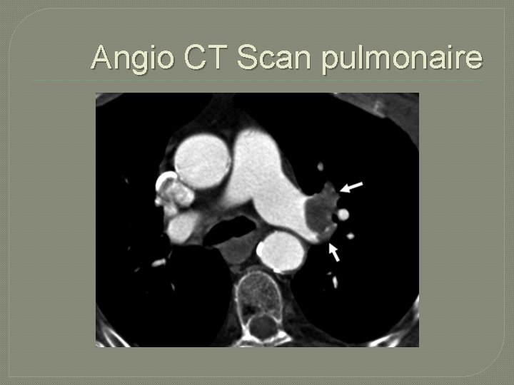 Angio CT Scan pulmonaire 