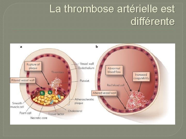 La thrombose artérielle est différente 