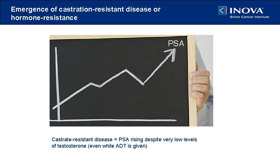 Emergence of castration-resistant disease or hormone-resistance PSA Castrate-resistant disease = PSA rising despite very