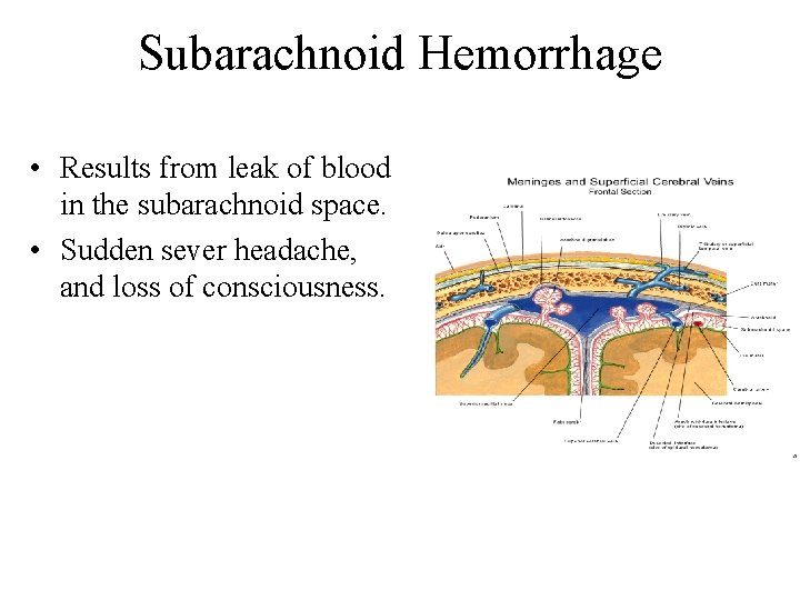 Subarachnoid Hemorrhage • Results from leak of blood in the subarachnoid space. • Sudden