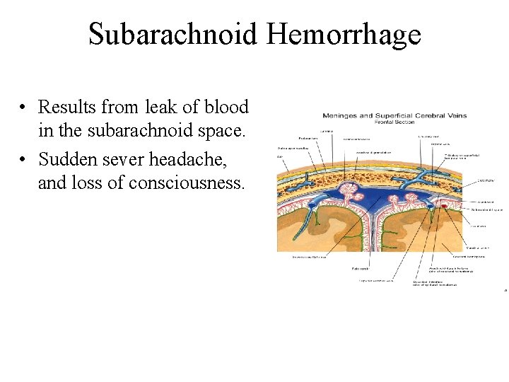 Subarachnoid Hemorrhage • Results from leak of blood in the subarachnoid space. • Sudden Subarachnoid Hemorrhage • Results from leak of blood in the subarachnoid space. • Sudden